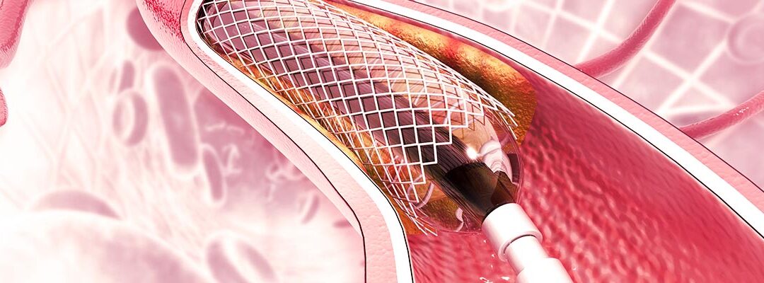 Clinica del occidente pionera en tecnologia cardiovascular
